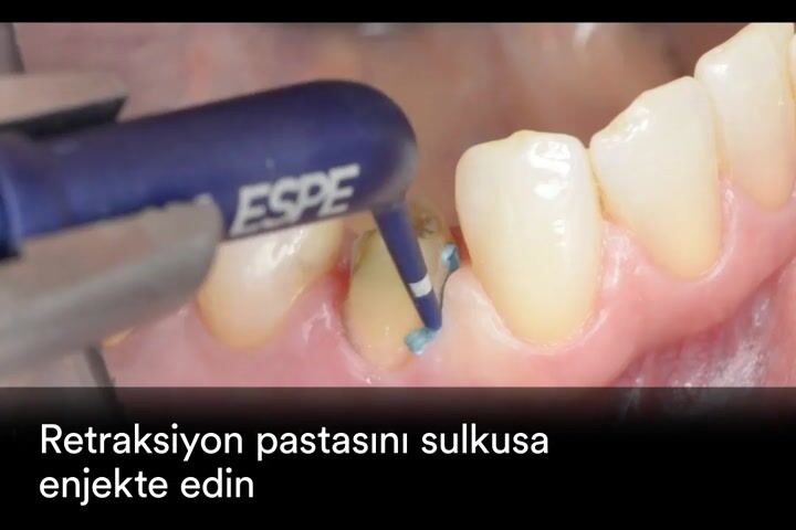 3M™ Astringent Retraction Paste Nasıl Kullanılır ?