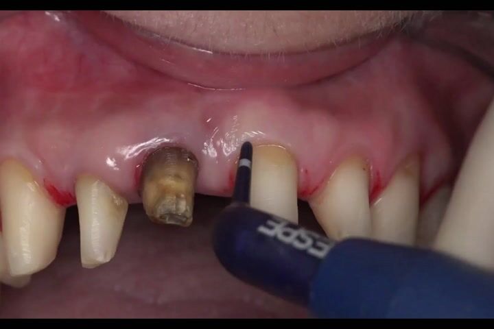 Basamaksız Diş Kesiminde Retraksiyon Pastası Kullanımı İçin İpuçları