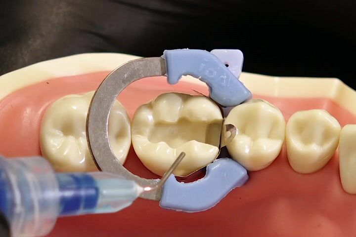 Derin Sınıf 2 Kavitelerde Filtek Bulk Fill Flow ve Filtek One Bulk Kompozitlerin Kombine Kullanım Rehberi