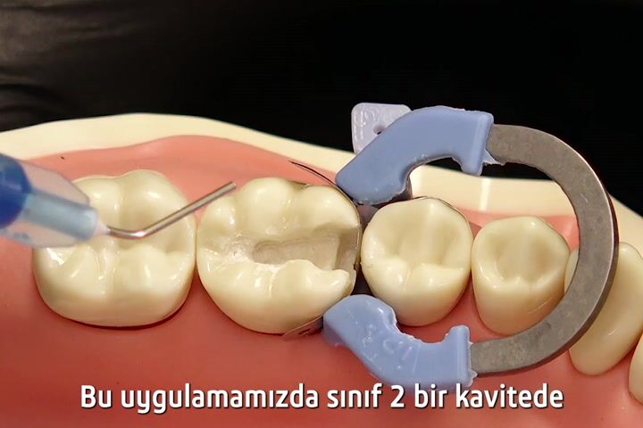 Sınıf 2 Kavitelerde Filtek One Bulk Fill Kullanım Rehberi