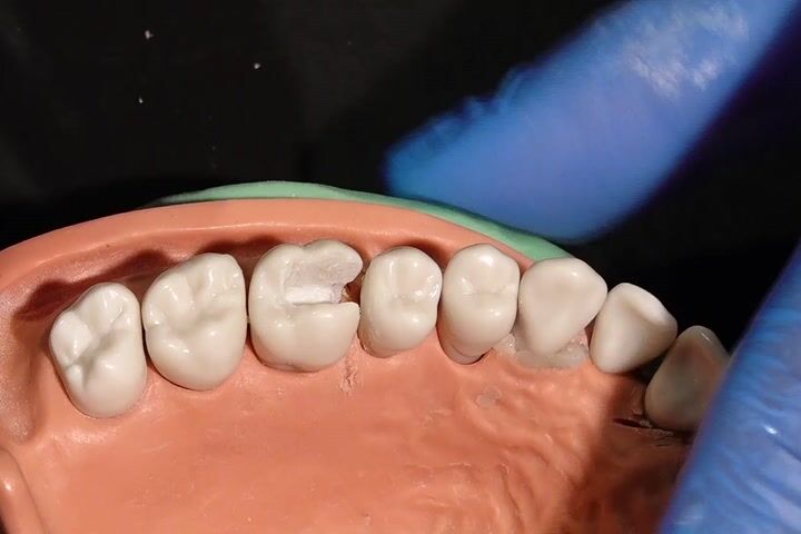 Posterior Arayüz Vakada Bioclear Posterior Matrix Seçim ve Uygulaması