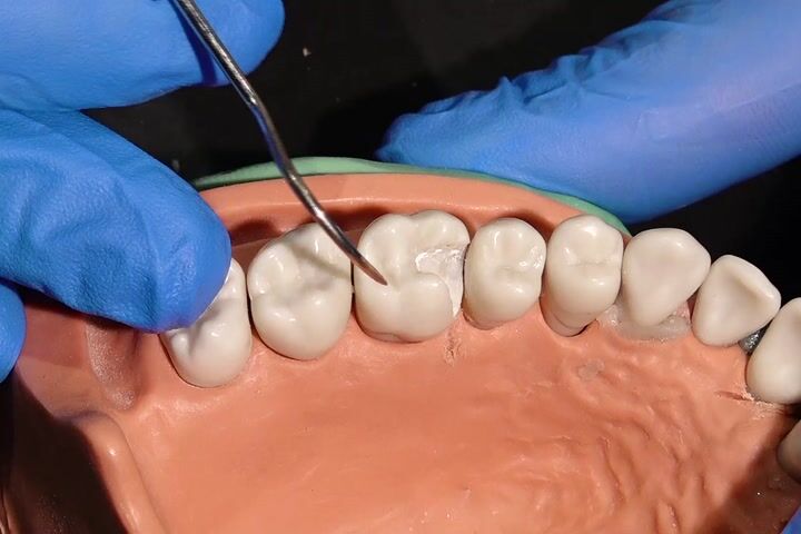 Geniş Posterior Arayüz Vakada Bioclear Matrix Uygulaması