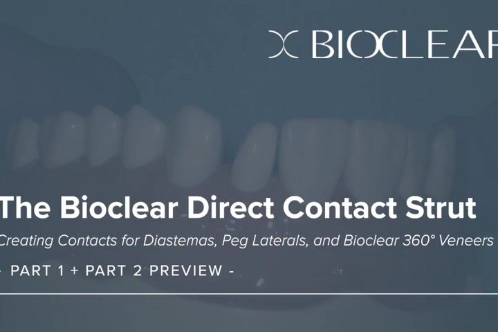 Bioclear™ Peg Lateral ve Diestemalarda Kontak Oluşturma