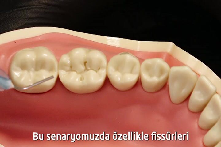Sığ Fissür Kavitelerinde Filtek Bulk Fill Flow ve Soflex Spiral Kullanım Rehberi