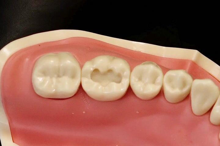 5mm'den daha az derinlikteki kavitelerde Filtek Easy Match Kullanım Rehberi