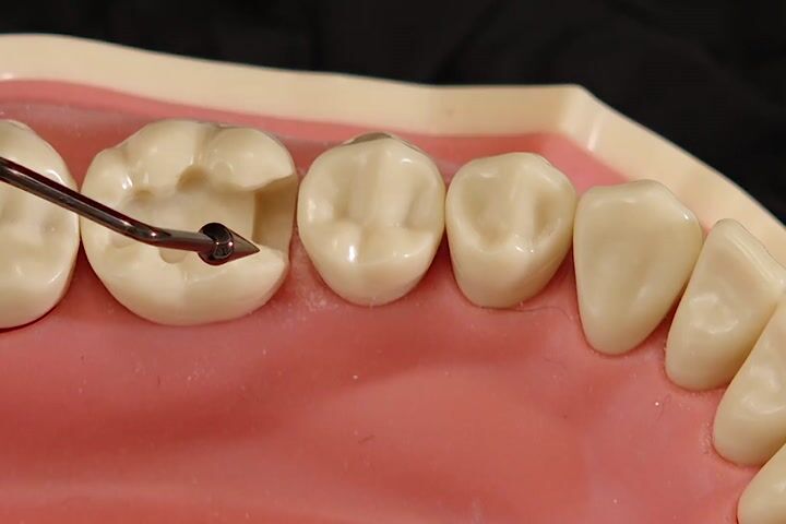 Total Pürüzlendirme tekniği