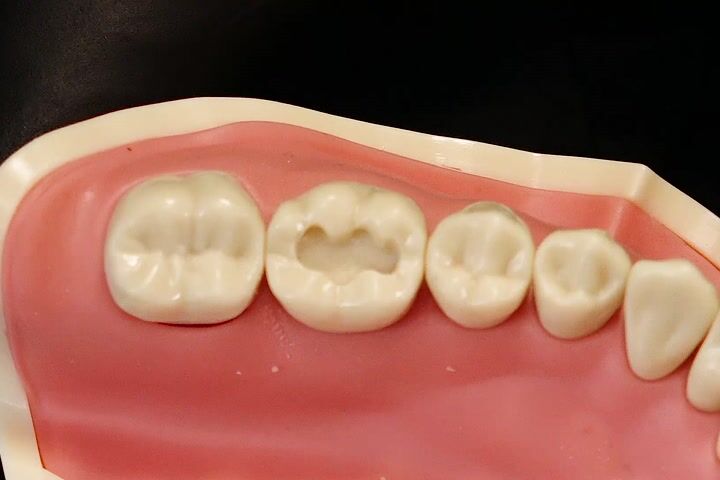 5mm'den daha az derinlikteki kavitelerde Filtek Easy Match Kullanım Rehberi