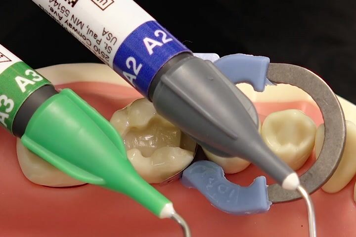Elastik Bağlanma Tekniği: Scotchbond Universal ve Filtek Supreme/BulkFill Flow ile Uygulama Rehberi